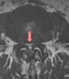 狭窄症の脊柱管MRI